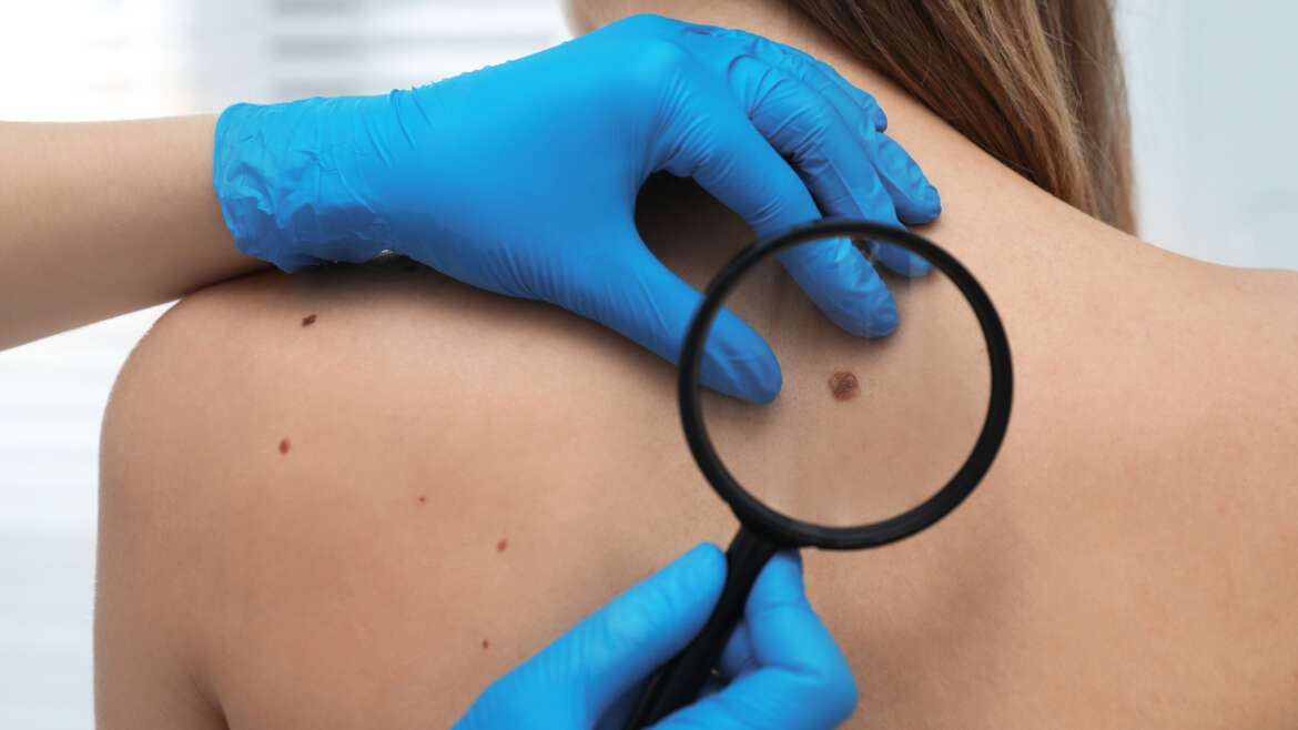 Nei, macchie e pelle dopo l’estate: quando è consigliabile una visita dermatologica