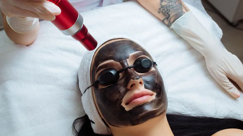 Carbon Peel il trattamento innovativo per una pelle luminosa e purificata