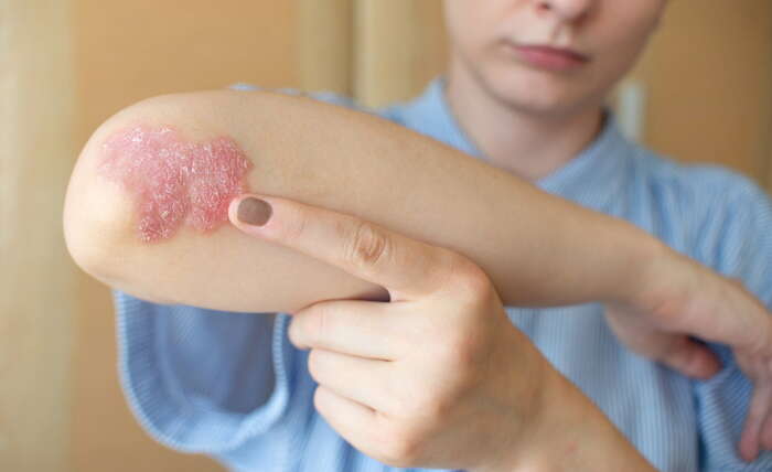 Psoriasi in estate: consigli utili per proteggere la pelle durante la bella stagione