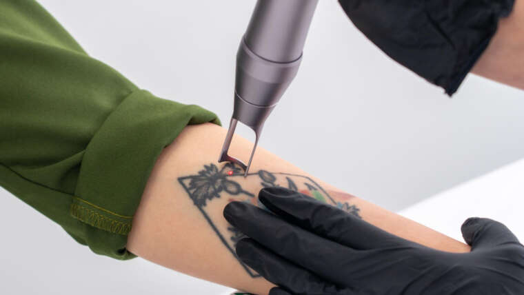Rimozione dei tatuaggi con il laser: come funziona il trattamento e quali risultati aspettarsi