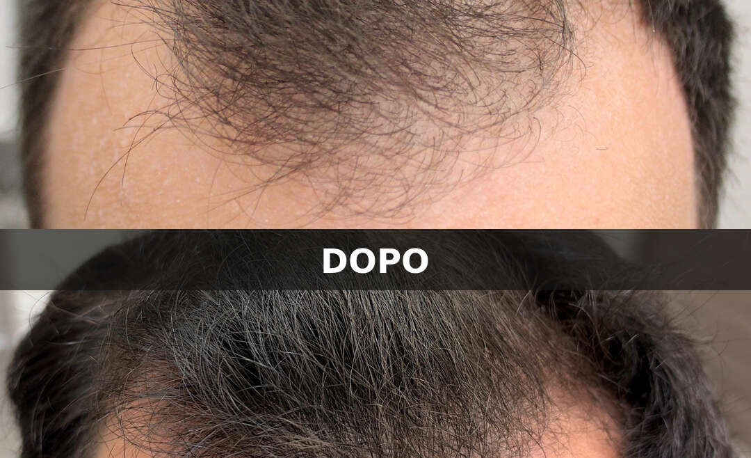 Alopecia androgenetica maschile: diagnosi con tricoscopia e risultati dopo 12 mesi di terapia