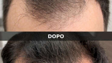 Alopecia androgenetica maschile: diagnosi con tricoscopia e risultati dopo 12 mesi di terapia