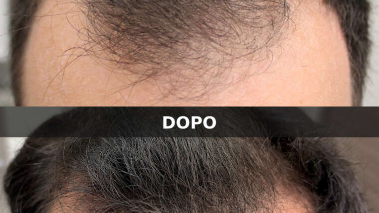 Alopecia androgenetica maschile: diagnosi con tricoscopia e risultati dopo 12 mesi di terapia